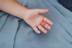 Mano di bambino con palmo arrossato